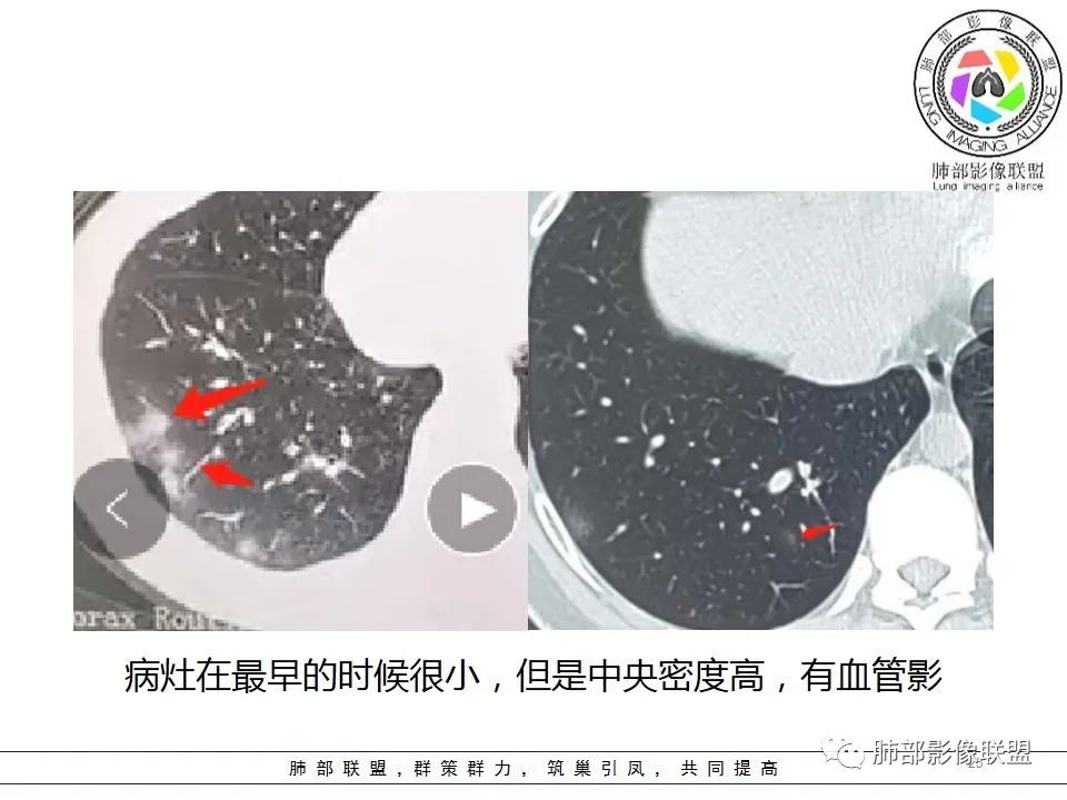 【PPT】如何快速掌握新冠肺炎（NCP）的影像识别？