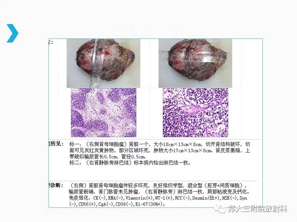 【PPT】小儿先天性胆总管囊肿CT诊断 【PPT】小儿先天性胆总管囊肿CT诊断