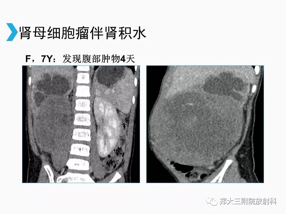 【PPT】小儿先天性胆总管囊肿CT诊断 【PPT】小儿先天性胆总管囊肿CT诊断