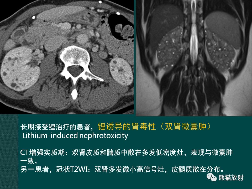 【PPT】肾脏囊性病变的CT及MRI表现 【PPT】肾脏囊性病变的CT及MRI表现