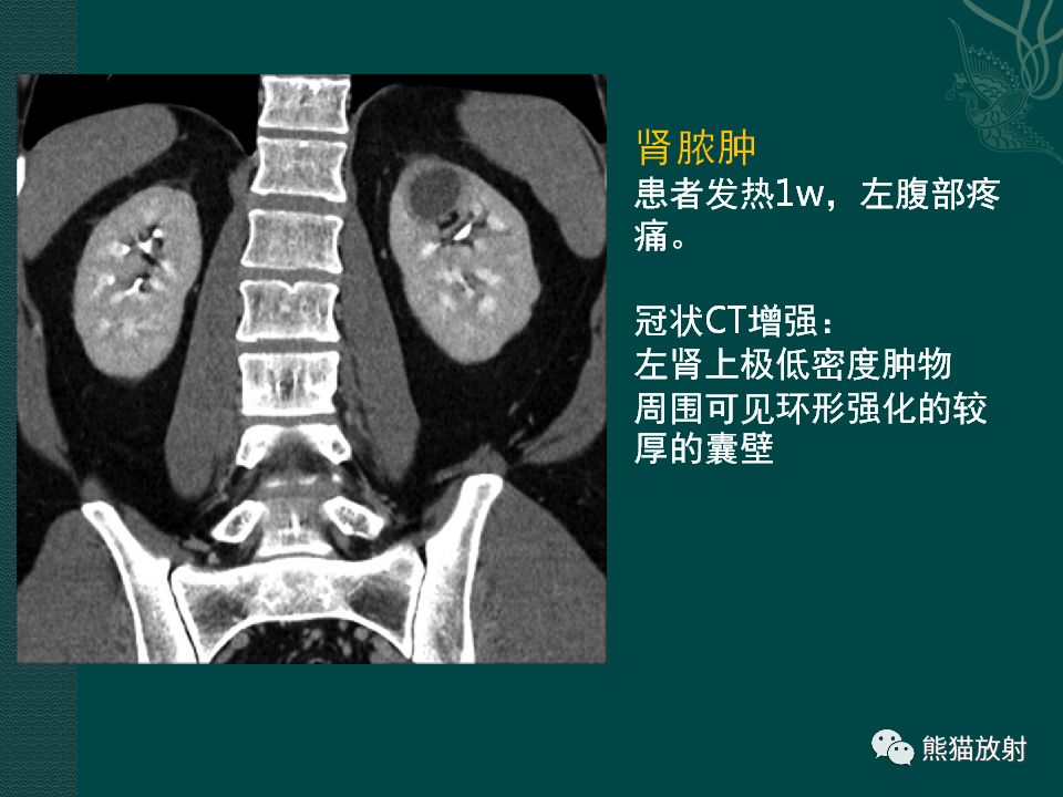 【PPT】肾脏囊性病变的CT及MRI表现 【PPT】肾脏囊性病变的CT及MRI表现