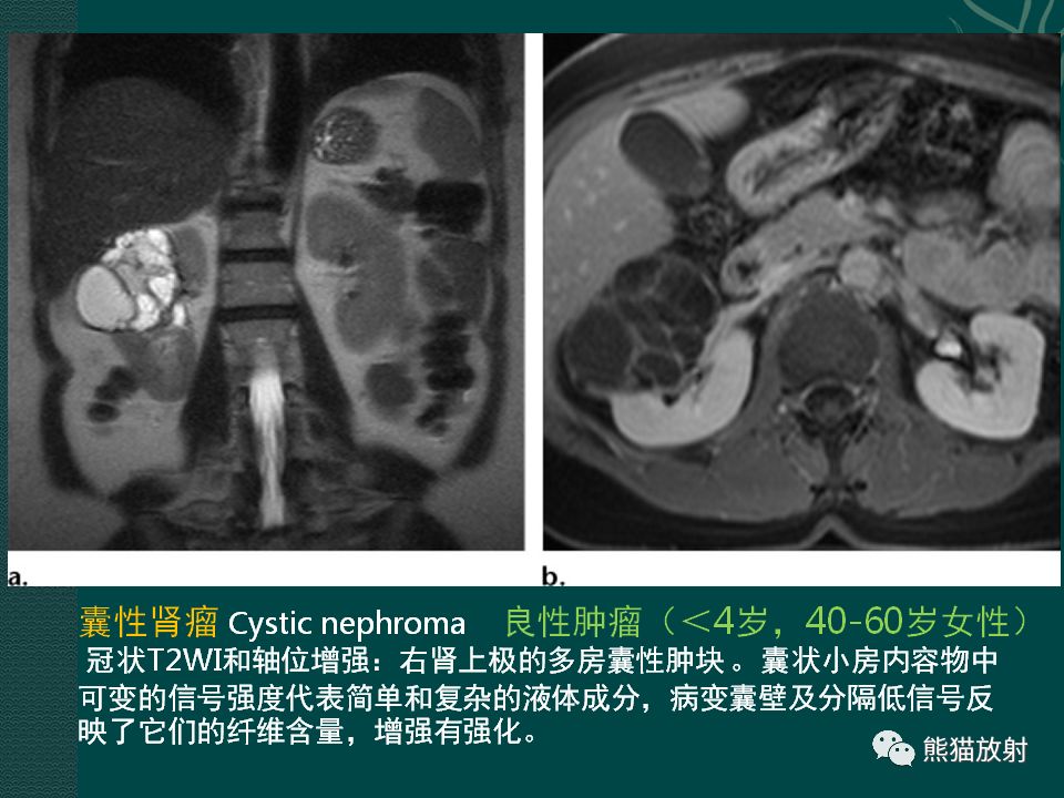 【PPT】肾脏囊性病变的CT及MRI表现 【PPT】肾脏囊性病变的CT及MRI表现