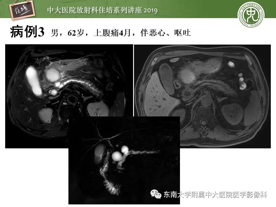 【PPT】胰腺炎的影像评估