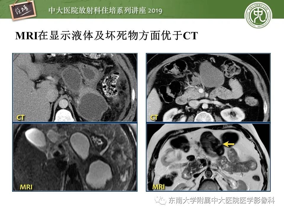 【PPT】胰腺炎的影像评估
