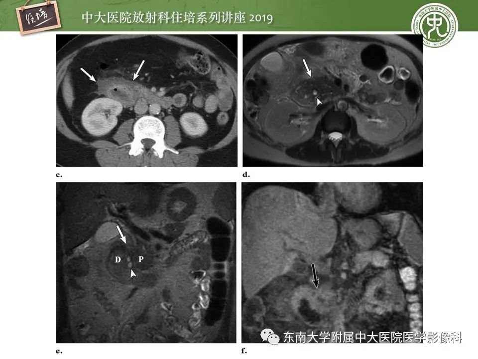 【PPT】胰腺炎的影像评估