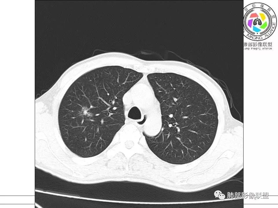 【病例】警惕结核背景下的腺癌