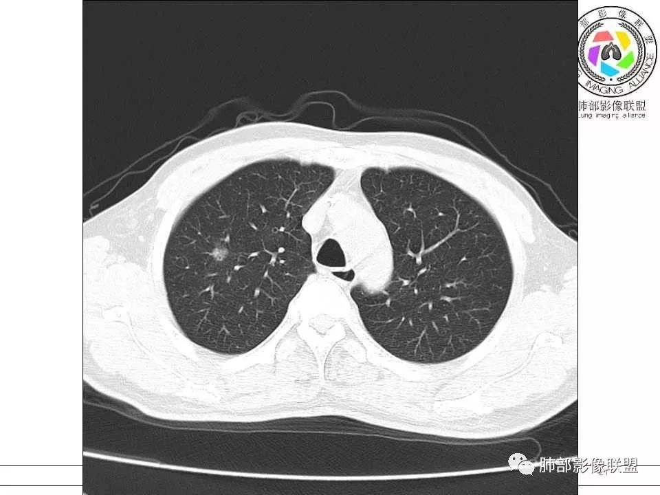 【病例】警惕结核背景下的腺癌