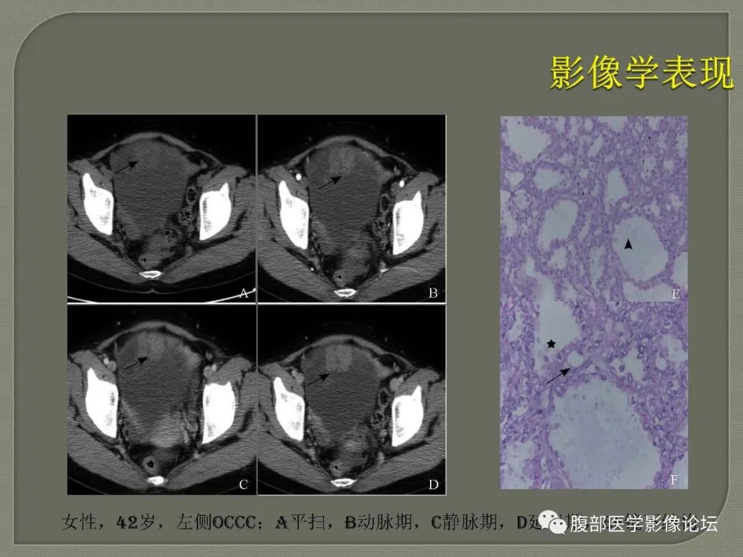 【病例】卵巢透明细胞癌1例MR影像