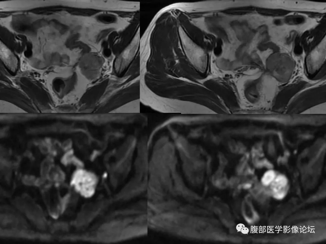 【病例】卵巢透明细胞癌1例MR影像
