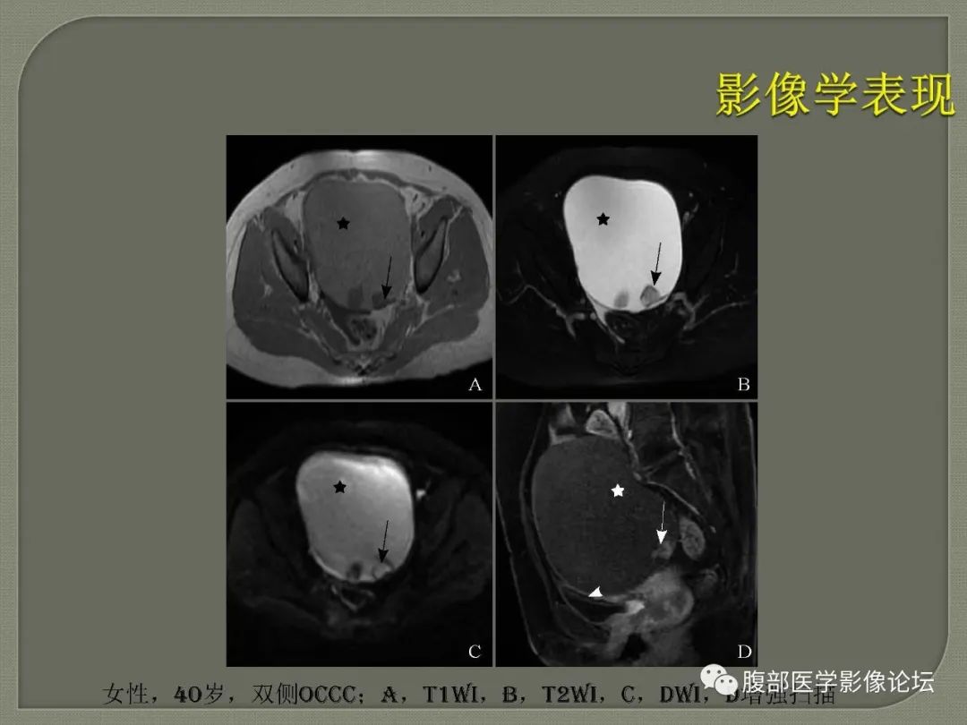 【病例】卵巢透明细胞癌1例MR影像