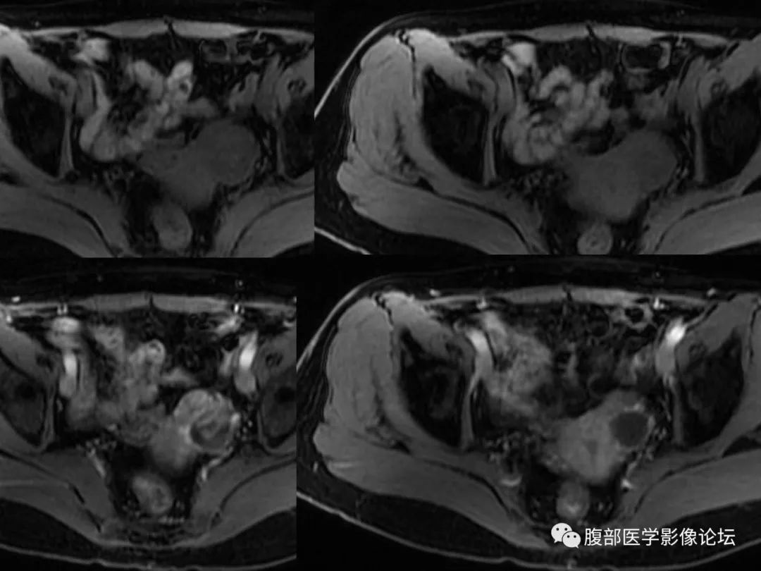 【病例】卵巢透明细胞癌1例MR影像