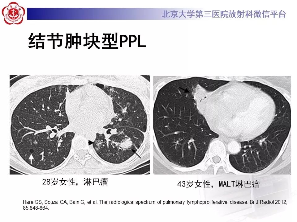【病例】原发性肺淋巴瘤1例CT影像