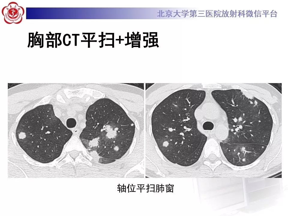 【病例】原发性肺淋巴瘤1例CT影像