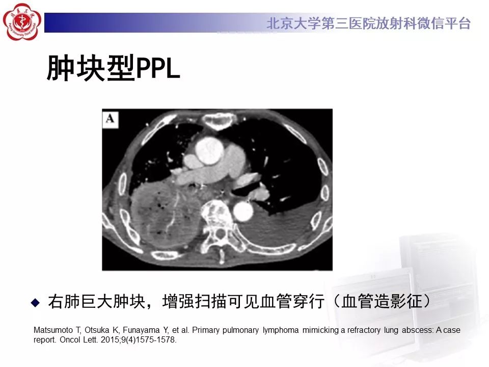 【病例】原发性肺淋巴瘤1例CT影像