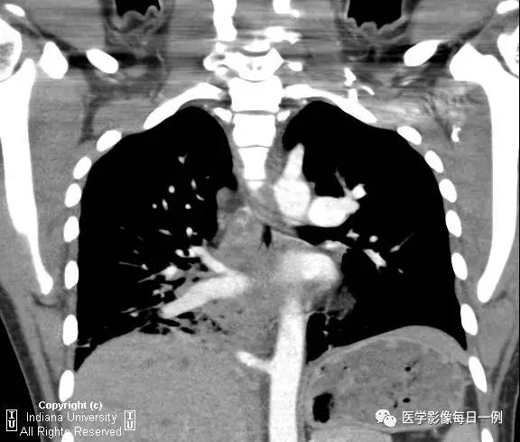 【病例】肺隔离症伴感染1例CT影像表现