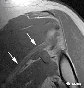 【病例】肩胛上神经卡压综合征1例MR