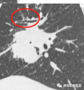 【病例】妖魔合体—你想不到的肉瘤样癌