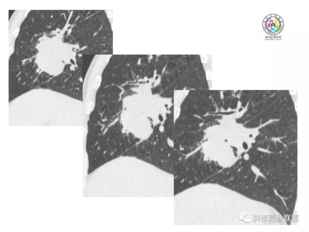 【病例】妖魔合体—你想不到的肉瘤样癌