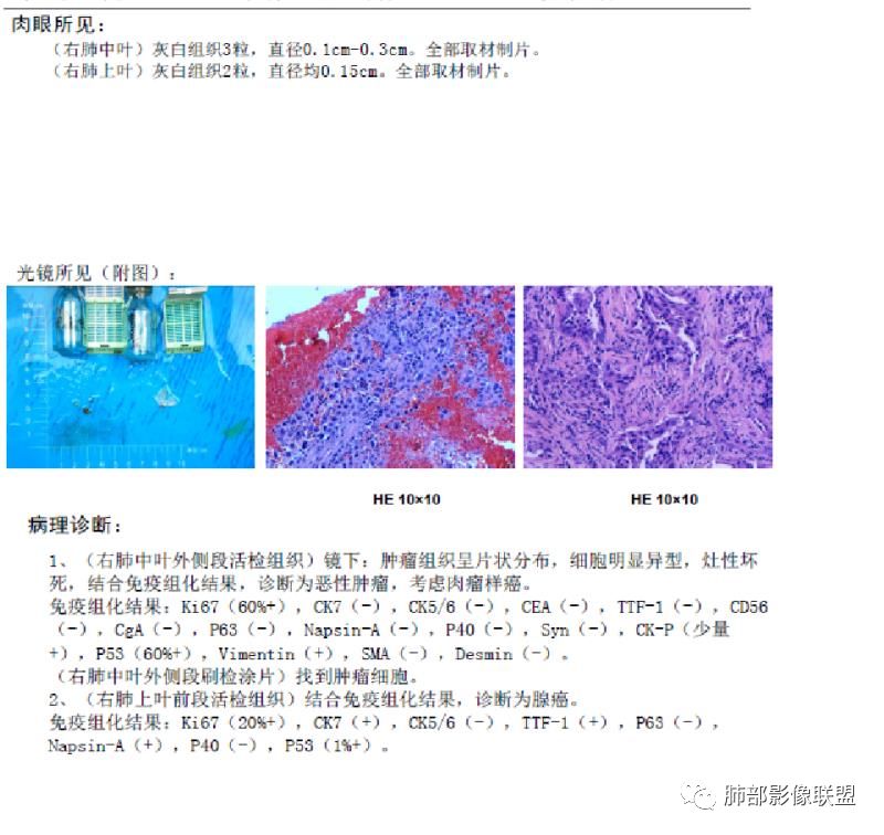 【病例】妖魔合体—你想不到的肉瘤样癌