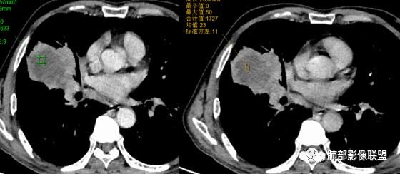 【病例】妖魔合体—你想不到的肉瘤样癌