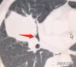 【病例】妖魔合体—你想不到的肉瘤样癌