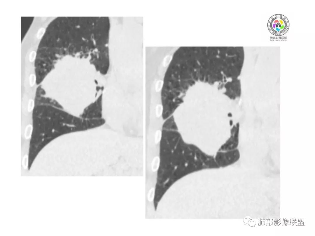 【病例】妖魔合体—你想不到的肉瘤样癌