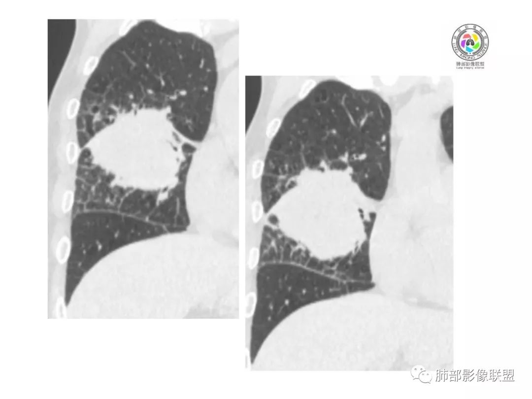 【病例】妖魔合体—你想不到的肉瘤样癌