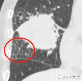【病例】妖魔合体—你想不到的肉瘤样癌