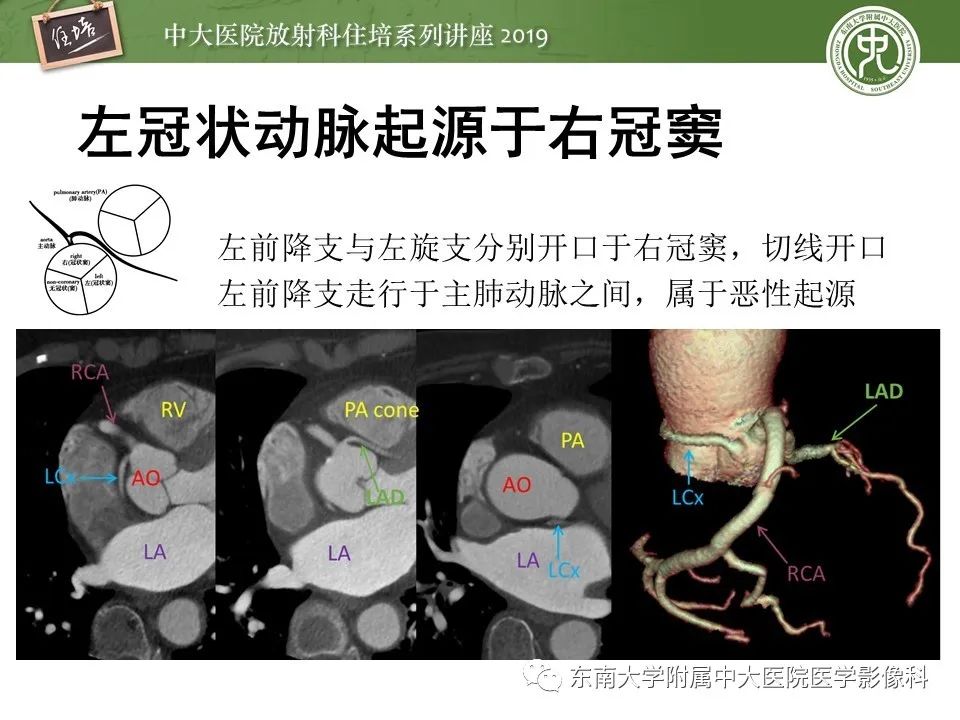 【PPT】冠状动脉CTA诊断流程