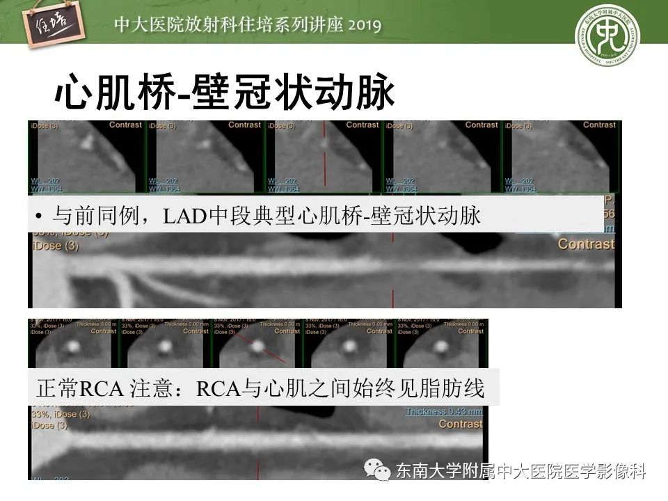 【PPT】冠状动脉CTA诊断流程