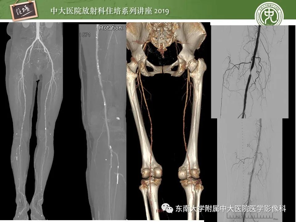 【PPT】下肢CTA的检查流程及评价