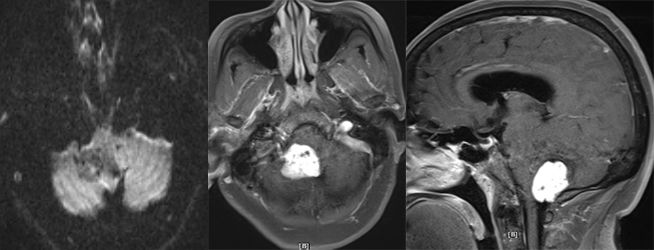 血管母细胞瘤 MRI 表现 血管母细胞瘤 MRI 表现