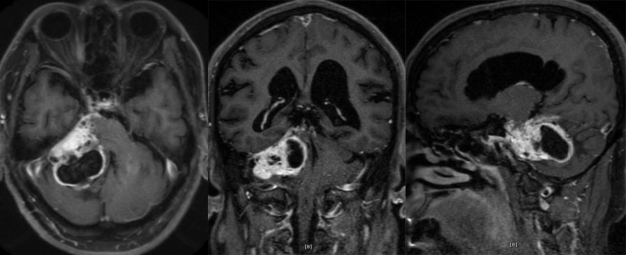 血管母细胞瘤 MRI 表现