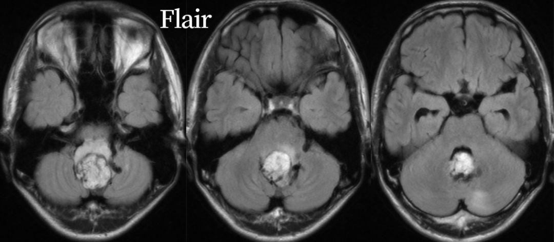 血管母细胞瘤 MRI 表现 血管母细胞瘤 MRI 表现