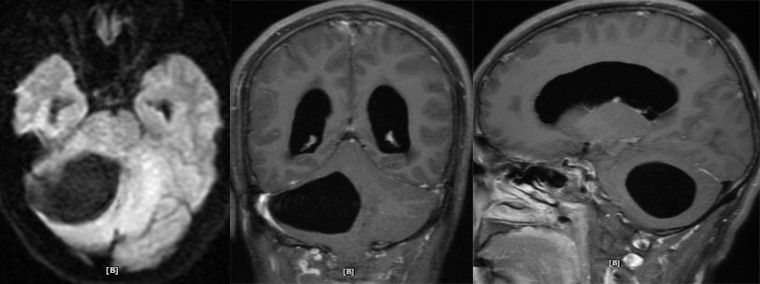血管母细胞瘤 MRI 表现 血管母细胞瘤 MRI 表现