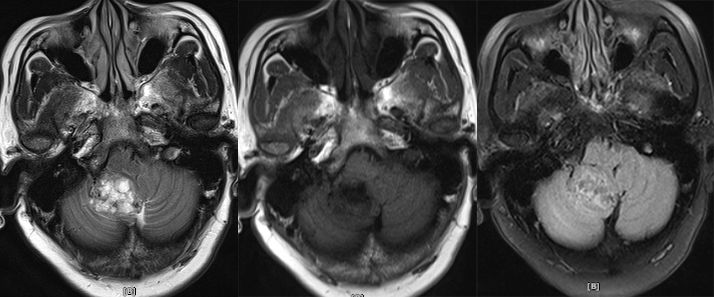 血管母细胞瘤 MRI 表现 血管母细胞瘤 MRI 表现
