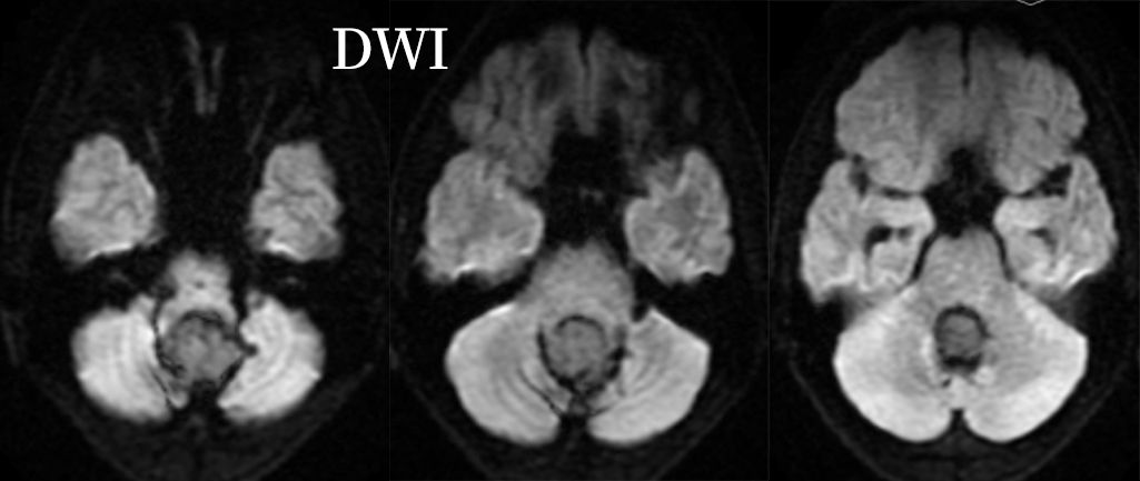 血管母细胞瘤 MRI 表现 血管母细胞瘤 MRI 表现