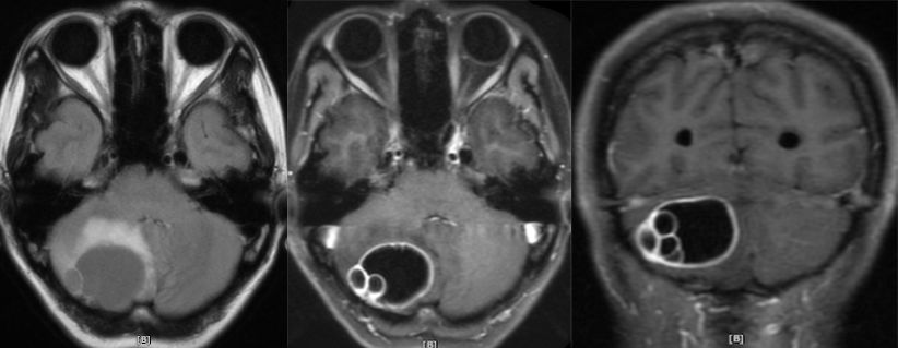 血管母细胞瘤 MRI 表现