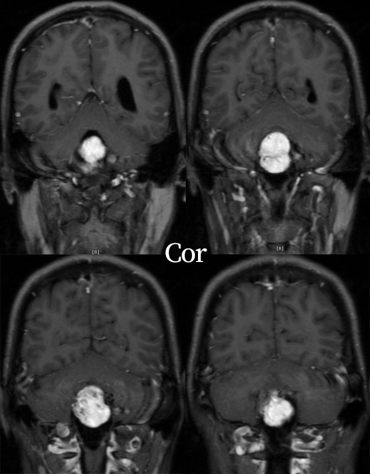 血管母细胞瘤 MRI 表现 血管母细胞瘤 MRI 表现