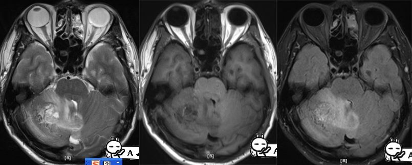 血管母细胞瘤 MRI 表现