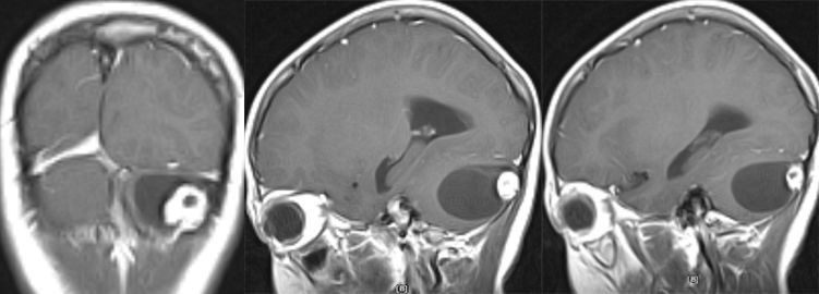 血管母细胞瘤 MRI 表现 血管母细胞瘤 MRI 表现