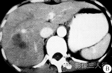 【病例】肝右叶炎性假瘤1例CT影像表现 【病例】肝右叶炎性假瘤1例CT影像表现