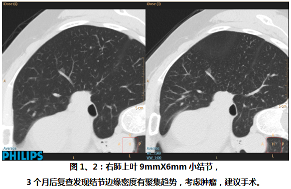 【病例学习】病理证实为原位的肺GGO一例