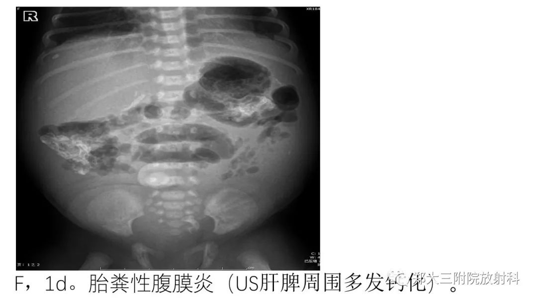 【PPT】新生儿坏死性小肠结肠炎 【PPT】新生儿坏死性小肠结肠炎