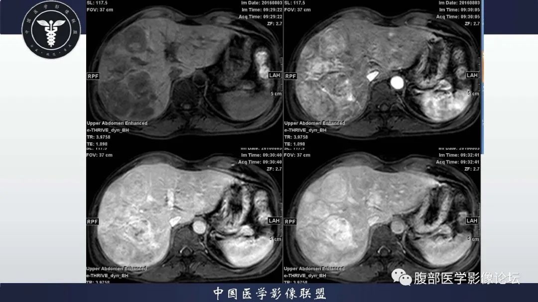 【病例】肝脏