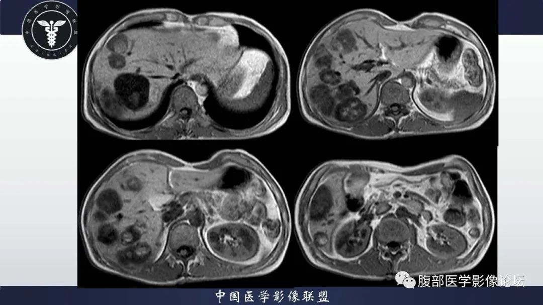 【病例】肝脏