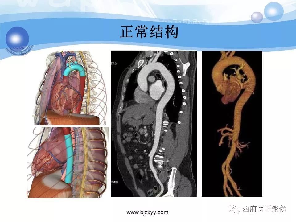 【PPT】主动脉壁间血肿的CT诊断