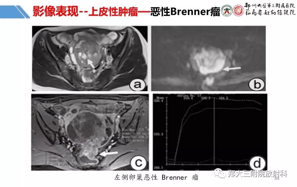 【PPT】卵巢肿瘤的影像诊断思路