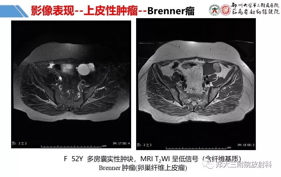 【PPT】卵巢肿瘤的影像诊断思路