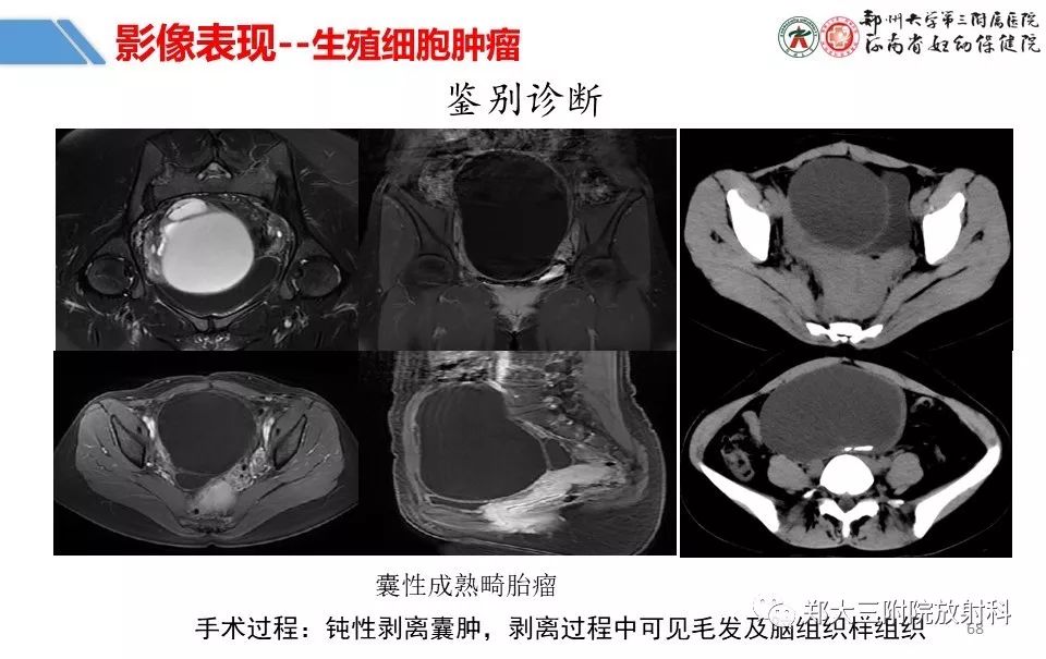 【PPT】卵巢肿瘤的影像诊断思路
